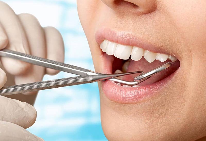 what are teeth cleaning and polishing
