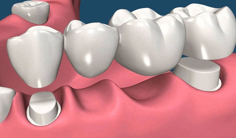 dental bridge animation