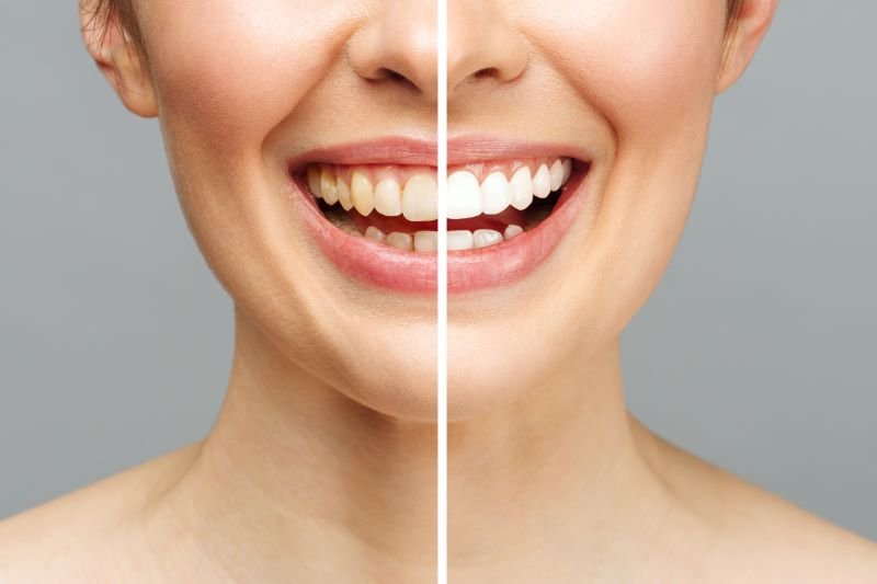 smile makeover price