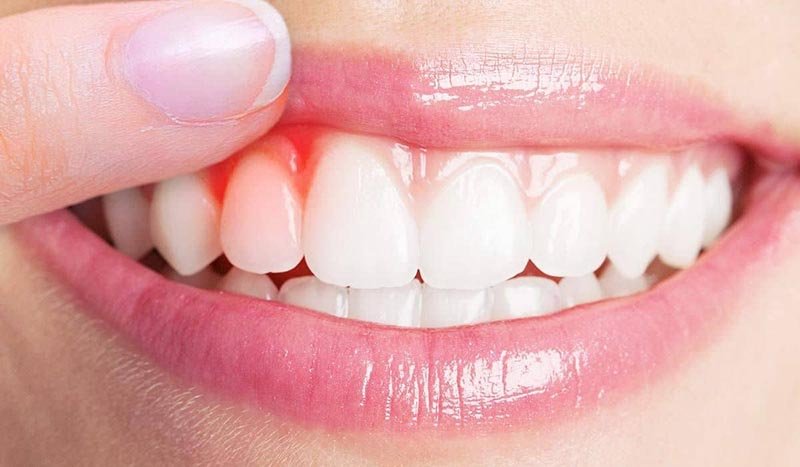 aggressive teeth brushing