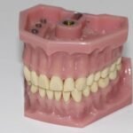 types of dentures
