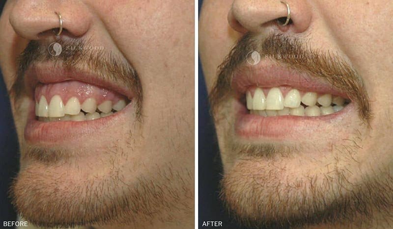 every detail about crown lengthening