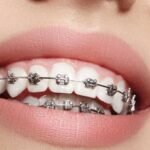 braces for orthodontic issues