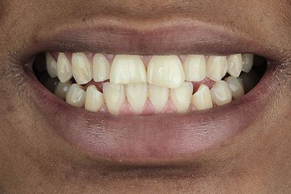 fatoumata1-before-zirconium-crowns