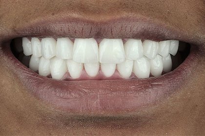 fatoumata2-after-zirconium-crowns