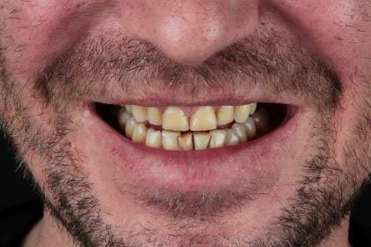 franky1-before-zirconium-crowns