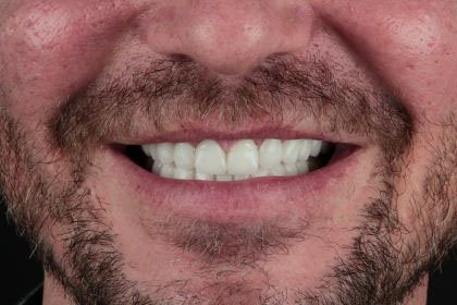 franky2-after-zirconium-crowns