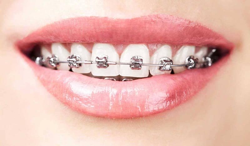 how do braces work