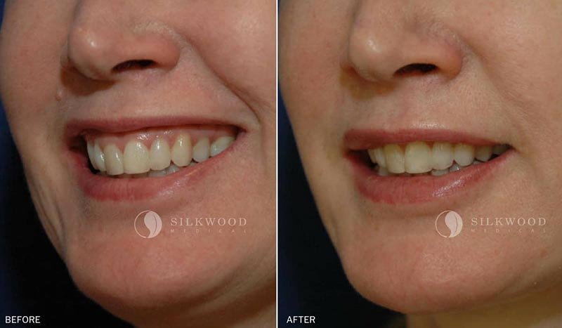 how painful is a gingivectomy