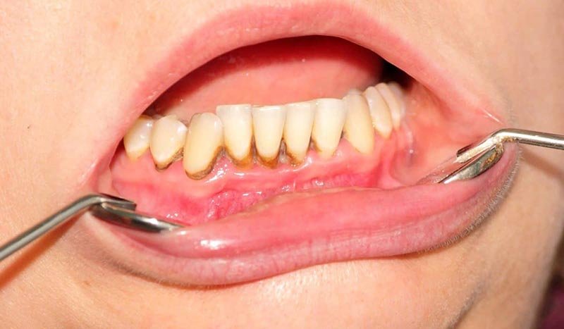 how to properly treat gum diseases