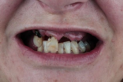 kayley1-before-hybrid-protheses-full-mouth-implants