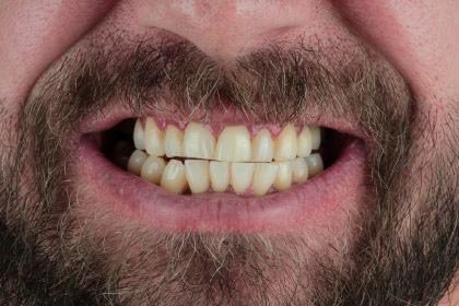 mark1-before-zirconium-crowns