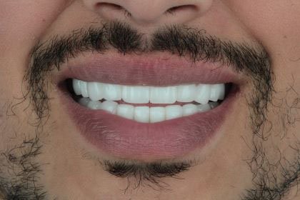 nabil2-after-zirconium-crowns