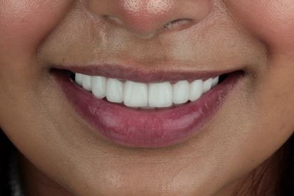 palwasha4-after-zirconium-crowns