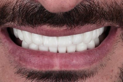 ramazan2-after-zirconium-crowns