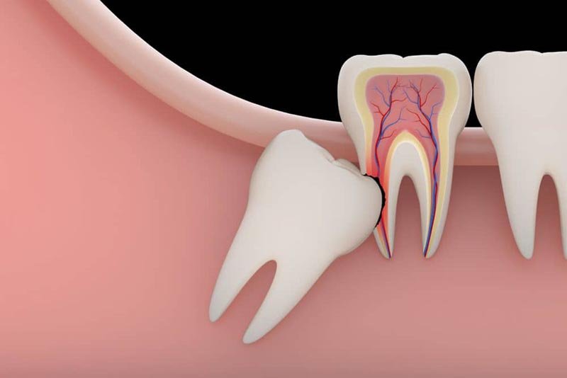 reasons for tooth extraction