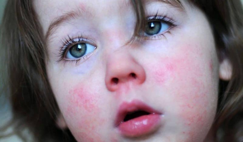 severe cases of strep throat