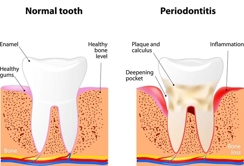 signs of gum disease