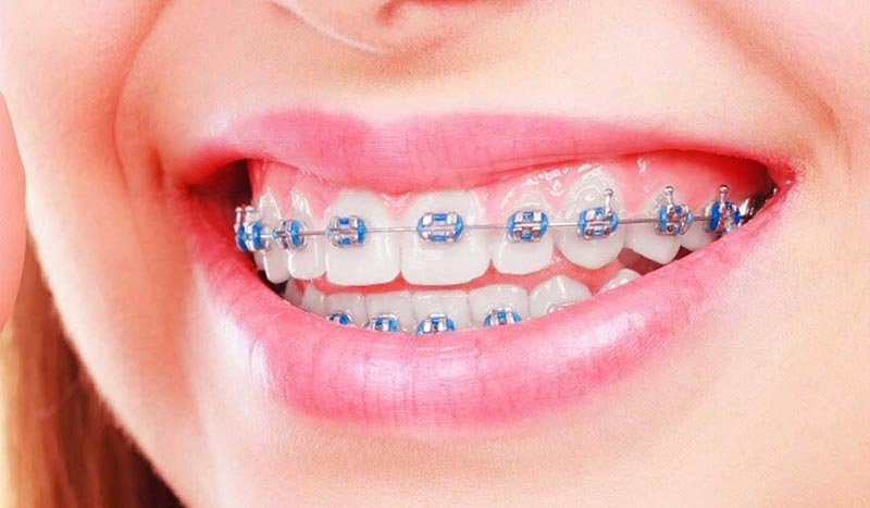 types of braces