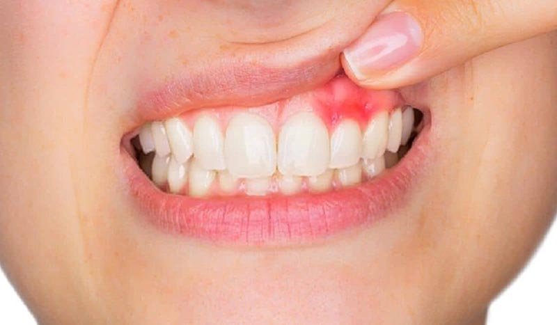 what are the differences between the gingivitis and the periodontitis