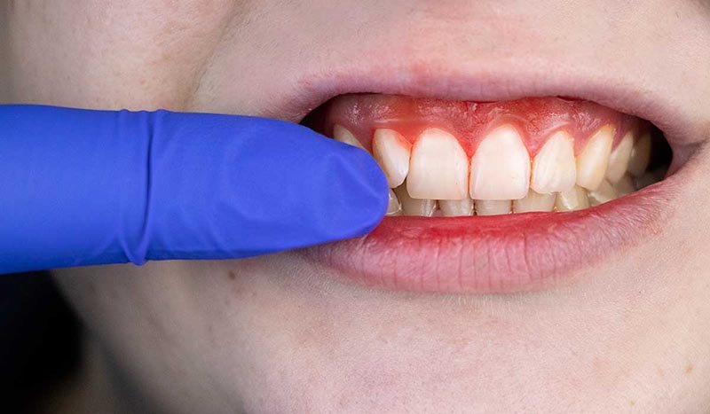 what are the differences between the gingivitis and the periodontitis