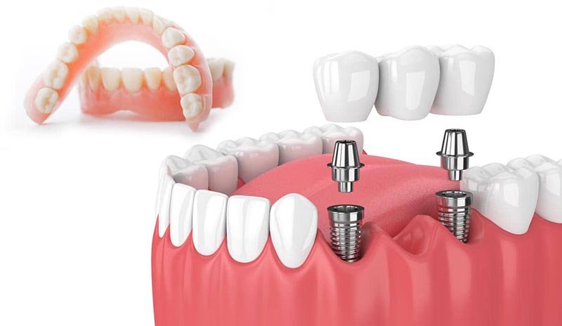 what better alternatives are for dentures