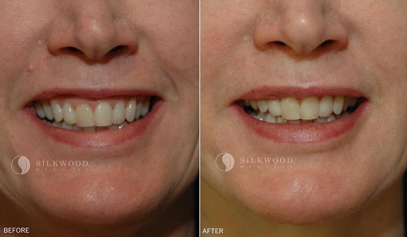 what does crown lengthening do