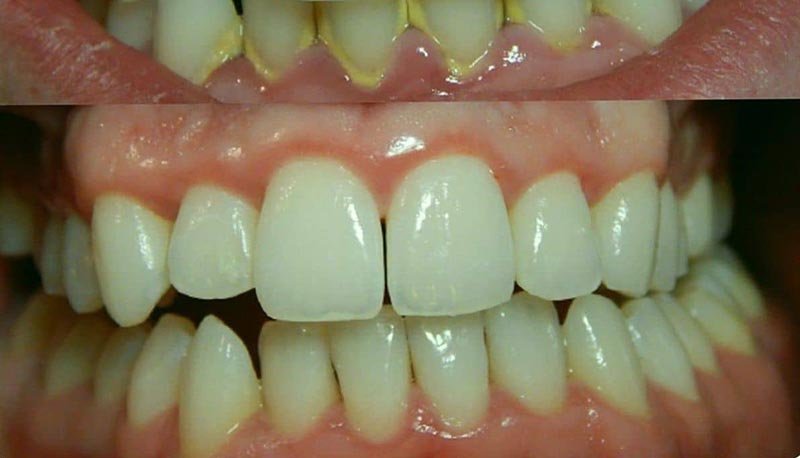 what happens if we forget to brush our teeth too many times