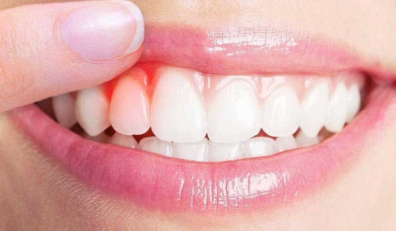 what is gingivectomy