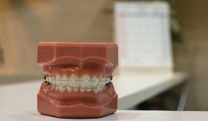 who can get braces and is there an age limit