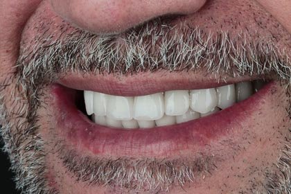 Garbis's photo after zirconium crowns by Dentvibe