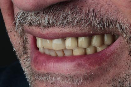 Garbis's photo before zirconium crowns by Dentvibe