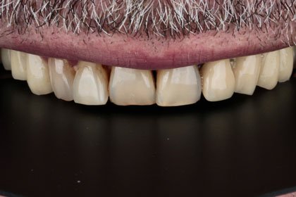 Johan's photo before zirconium crowns by Dentvibe