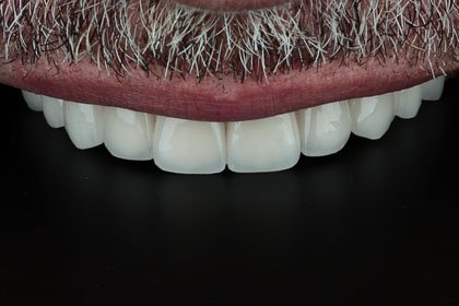 Johan's photo after zirconium crowns by Dentvibe