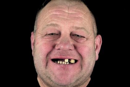 Les's photo before all-on-6 precision attachment prosthesis by Dentvibe