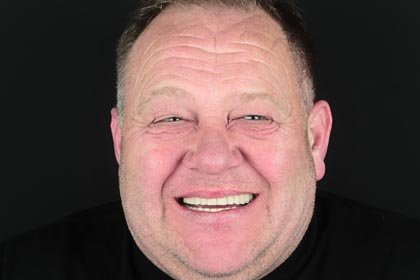 Les's photo after all-on-6 precision attachment prosthesis by Dentvibe