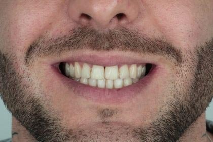Lukasz's photo before zirconium crowns by Dentvibe