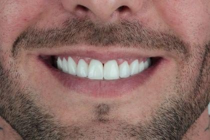 Lukasz's photo after zirconium crowns by Dentvibe
