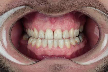 Lukasz's photo before zirconium crowns by Dentvibe