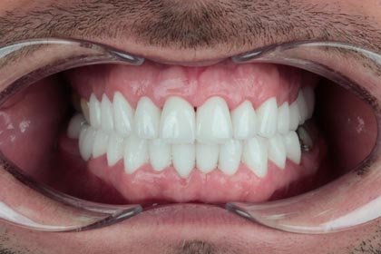 Lukasz's photo after zirconium crowns by Dentvibe
