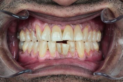 Nitesh's photo before zirconium crowns by Dentvibe