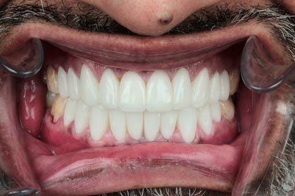 Nitesh's photo after zirconium crowns by Dentvibe
