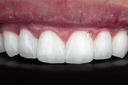Salim's photo after zirconium crowns by Dentvibe