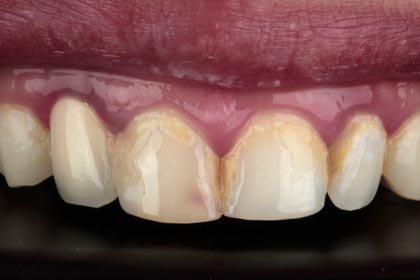 Salim's photo before zirconium crowns by Dentvibe
